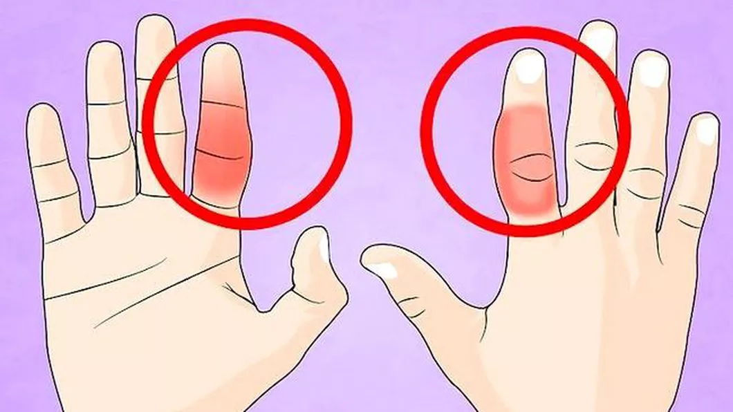 Cum tratezi un deget rupt și cum recunoști o astfel de fractură