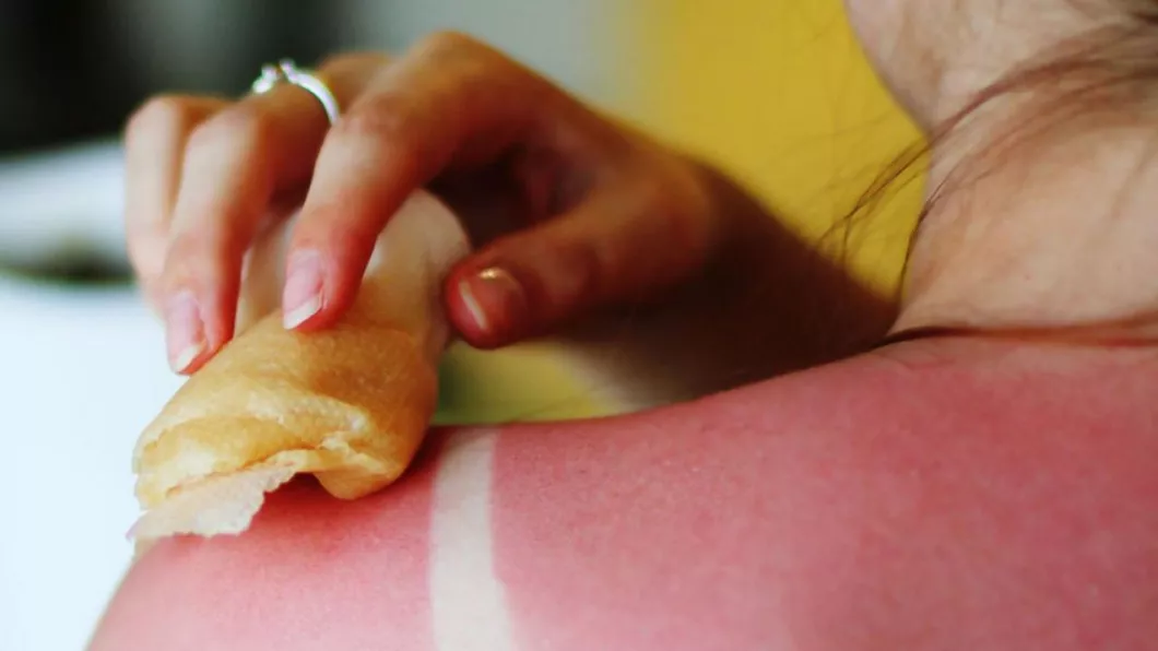 Medicii dermatologi din Iași fac o serie de recomandări despre cum să ne protejăm pielea de arsurile solare. Prof. dr. Laura Solovăstru Nu dăm cu iaurt și ouă pe pielea afectată de soare