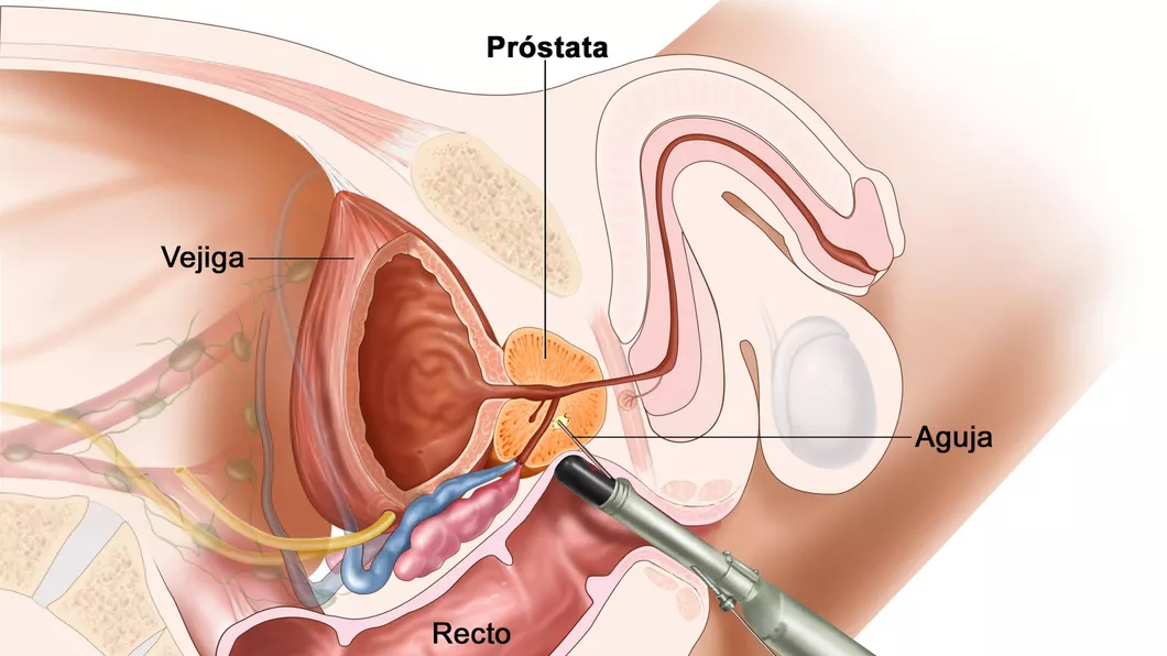 Legătura dintre dieta sănătoasă și prevenirea cancerului de prostată