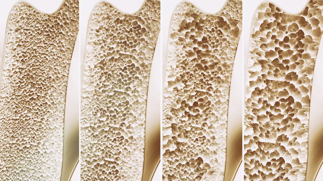 Osteoporoză 3 simptome pe care nu trebuie să le ignori