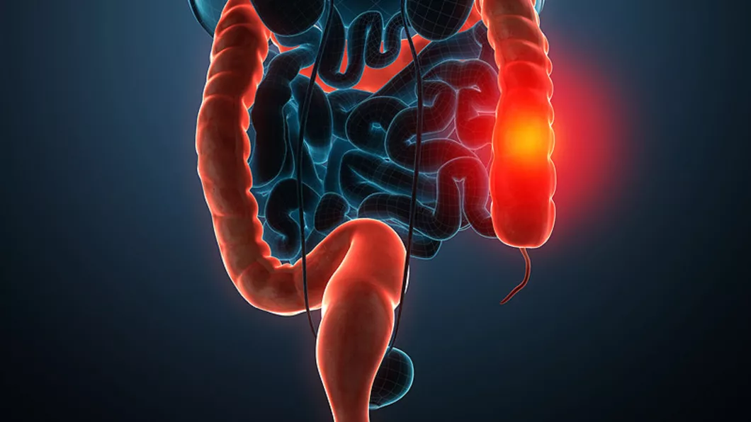 Simptomele stadiilor cancerului de colon