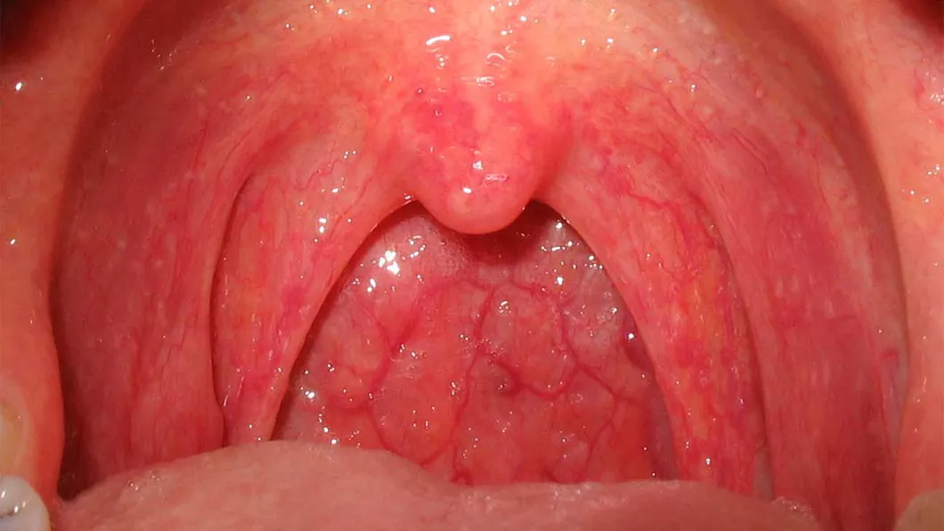 Cancerul gâtului simptome