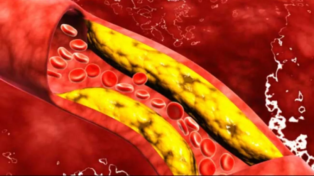 Cum putem scadea nivelul colesterolului din sânge
