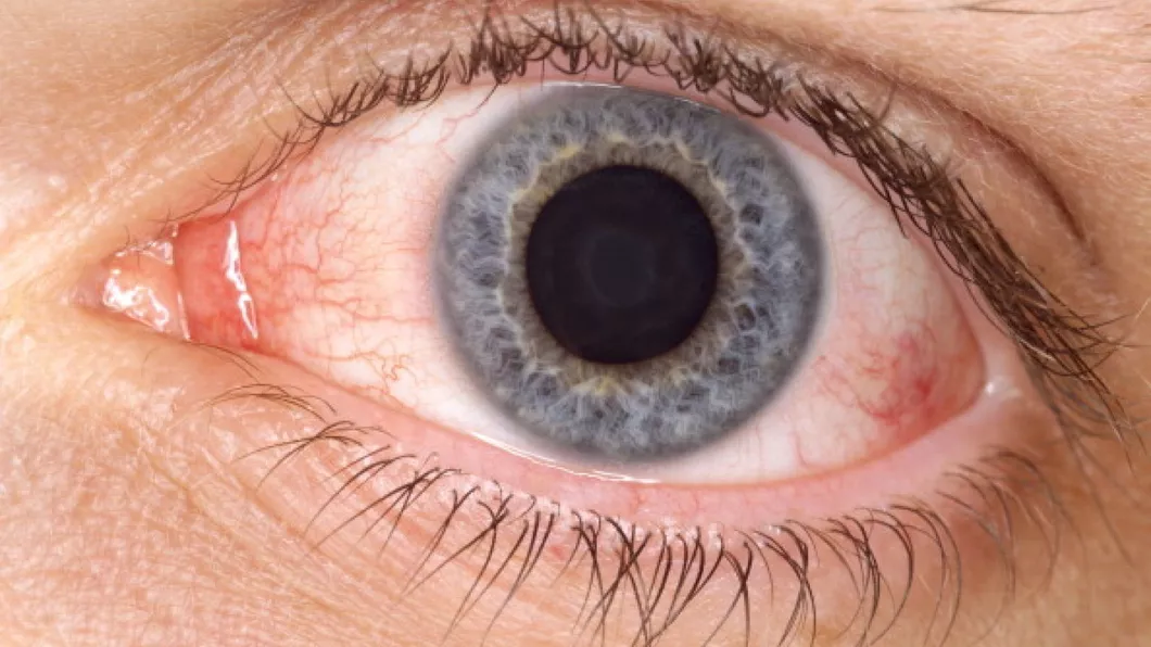 Ochiul uman pare rezistent la SARS-CoV-2 au stabilit oamenii de stiinta