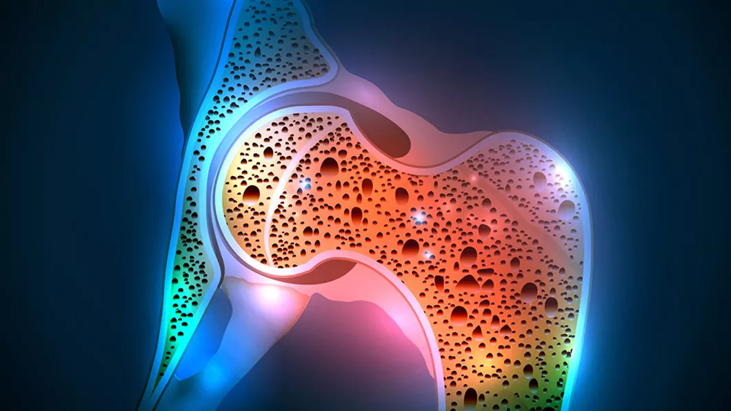 Tratamentul pentru osteoporoză ar proteja împotriva Covid-19