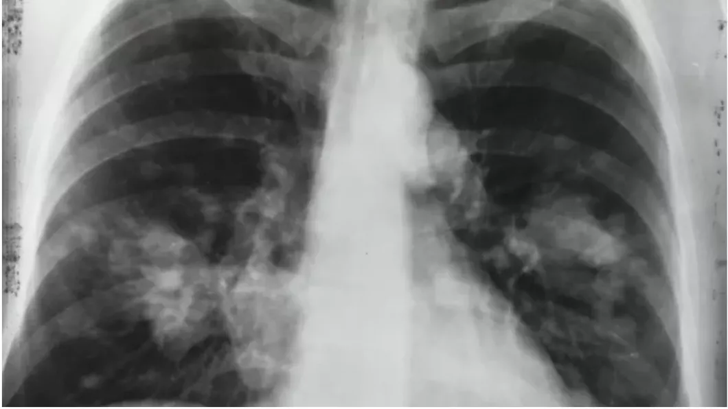 Cine este expus riscului de COVID lung Ce știu oamenii de știință până acum