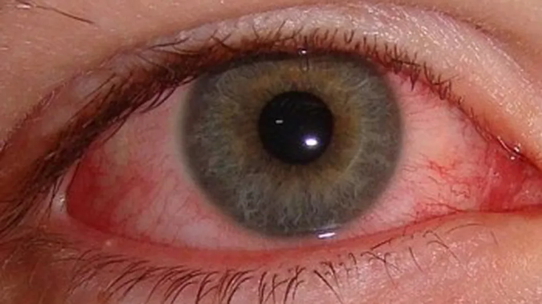 Curent la ochi Care sunt cauzele tratament și remedii naturiste