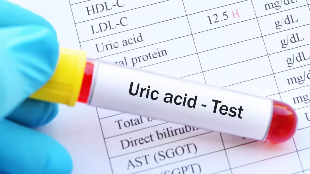 Acid uric seric Ce boli se pot ascunde în spatele valorilor mai mari sau mici