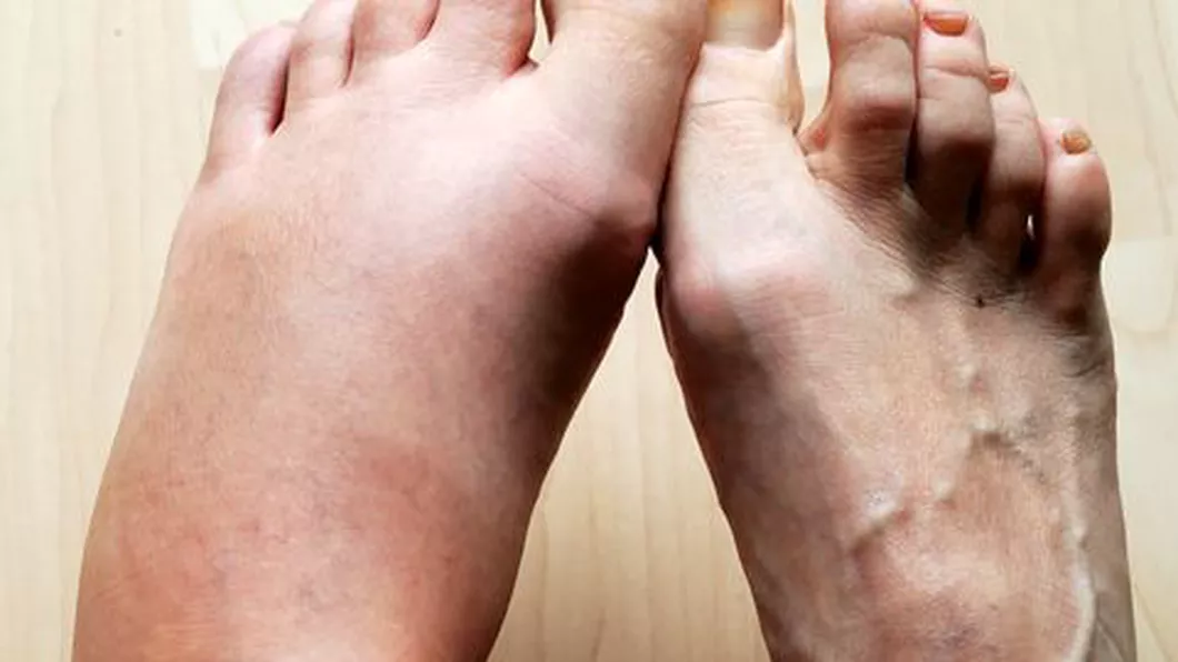 Suferi de picioare umflate Uite cele mai comune 8 cauze