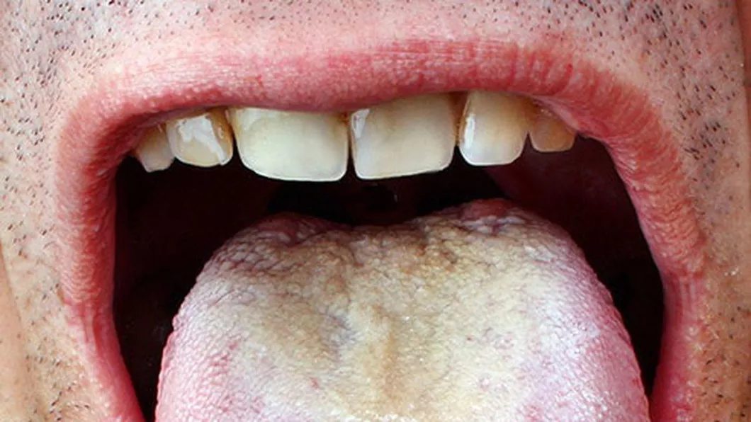 Candidoza bucală Tratament cu bicarbonat