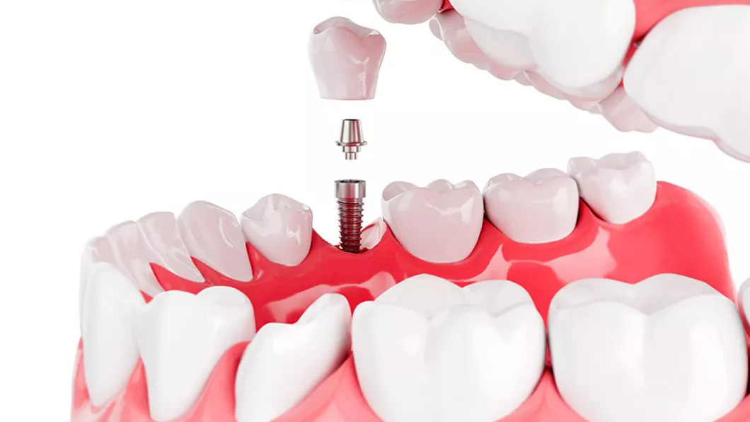 Avantajele implantului dentar. De ce ar trebui să alegi tratamentul cu implanturi dentare