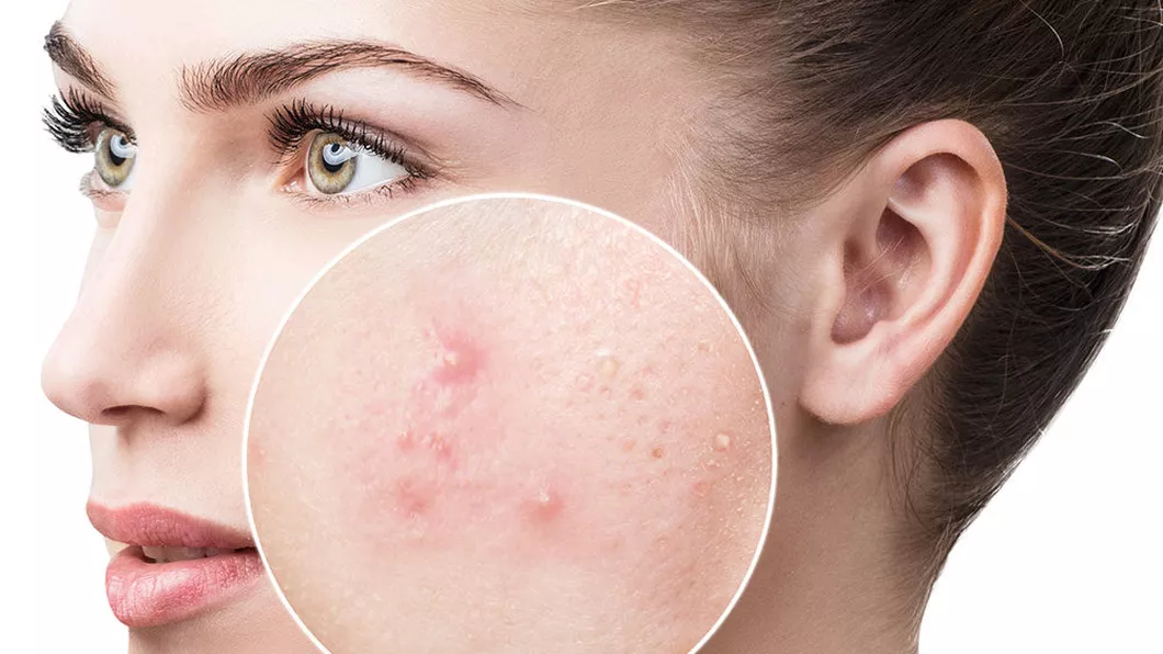 Cum scapi de acnee Soluții cu efecte rapide prescrise de dermatolog