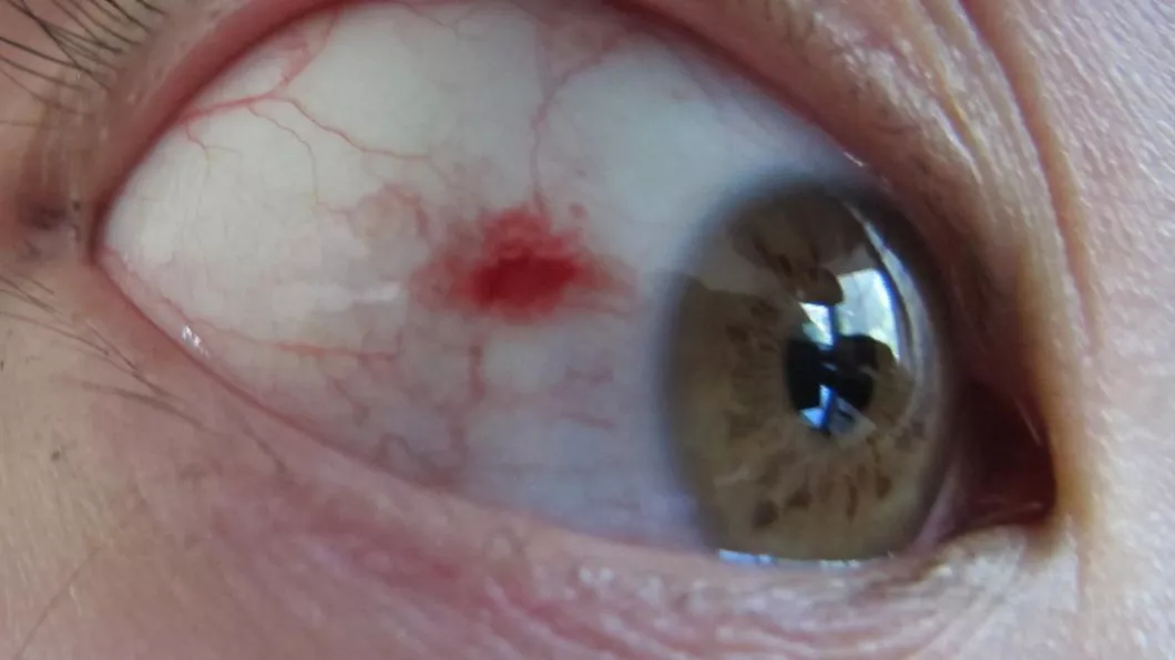 Punct roșu pe ochi Iată de ce plesnesc vasele de sânge la ochi și când ar trebui să te îngrijorezi