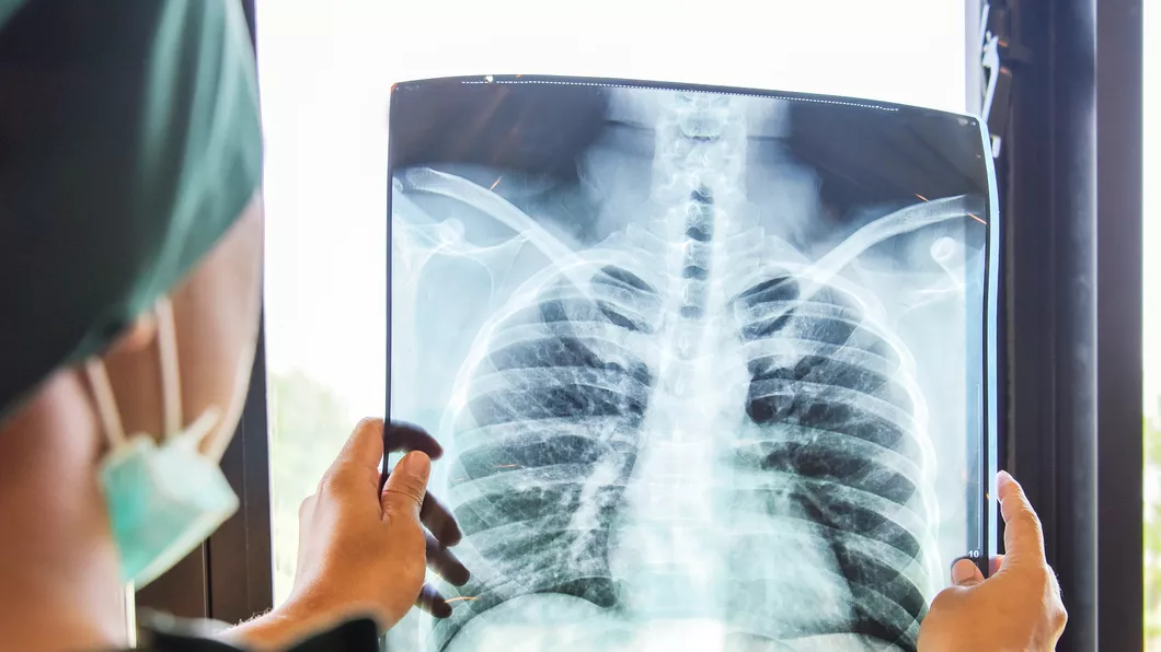Peste 1.000 de oameni din județul Suceava suferă de infecții acute ale căilor respiratorii și pneumonii