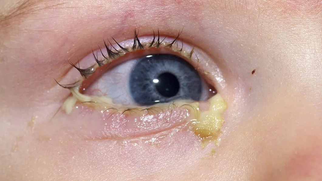 Secreție galbenă ochi bebeluș Din ce cauză apare disconfortul și cum să ameliorezi rapid simptomul
