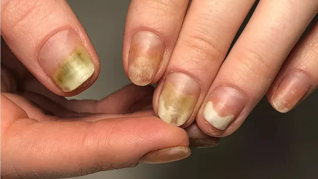 Mucegai pe unghie Cum să oprești rapid infecția