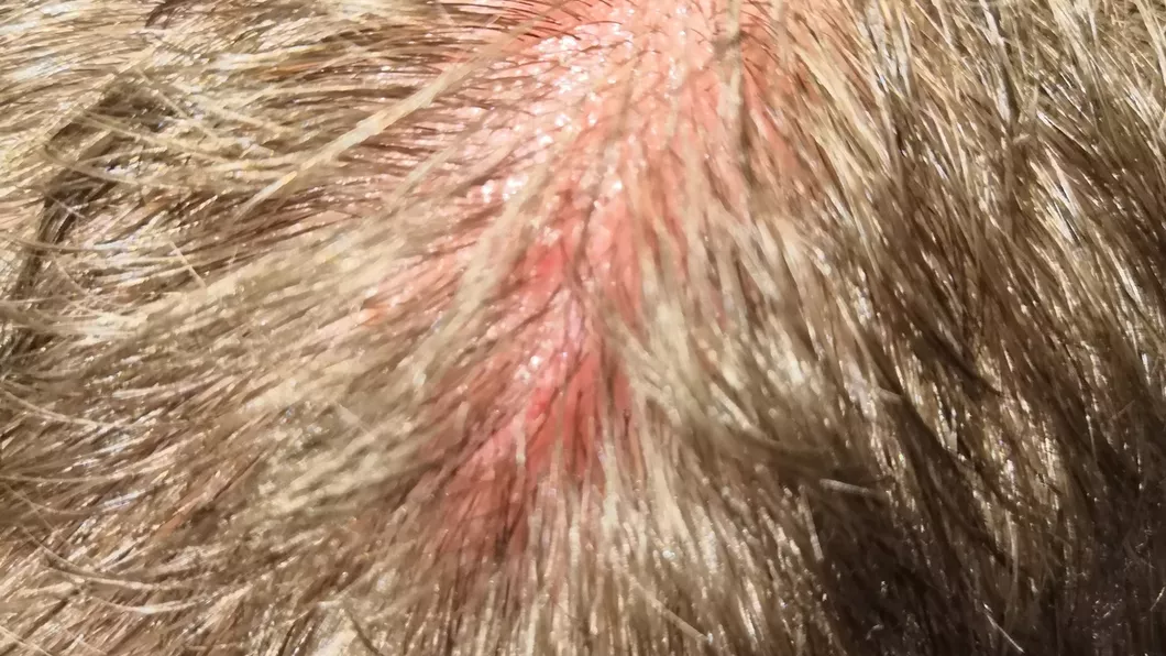 Pete roșii pe scalp Ce boli grave semnalează acest disconfort