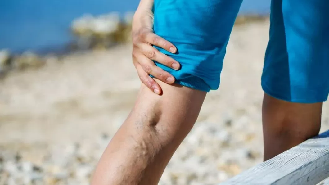 Tromboza venoasă picior poze Cum să ameliorezi umflăturile și durerile de la nivelul picioarelor