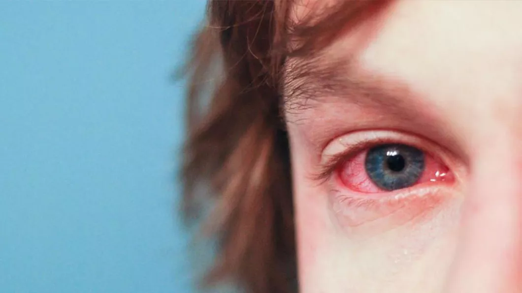 Ochii roșii la copii Cauze și motive de îngrijorare