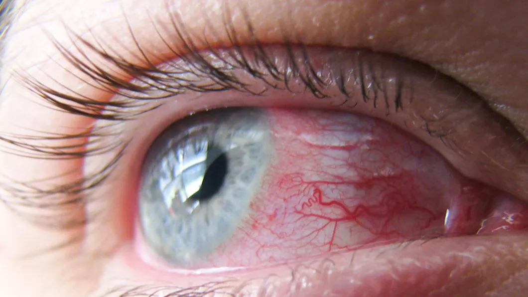 Ochiul roșu și umflat o urgență oftalmologică Cauze și tratament