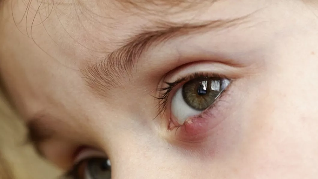 Ce simptome prezintă ulciorul la ochi și cum se tratează Tratament rapid acasă