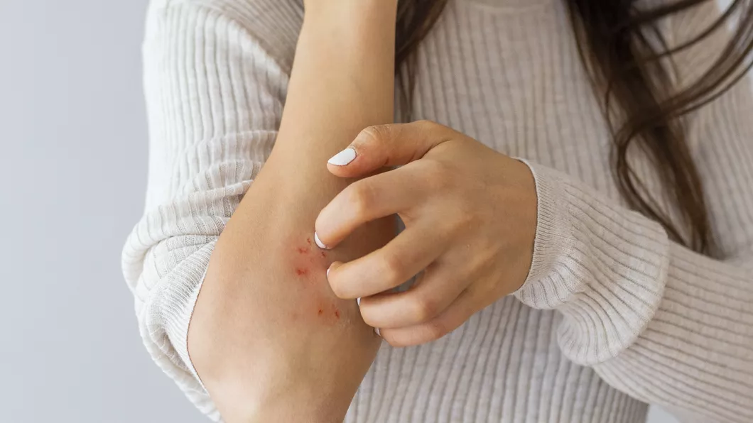 Ce este eczema și ce tratament recomandă medicii pentru ameliorarea simptomelor Iată cum prepari un unguent eficient acasă