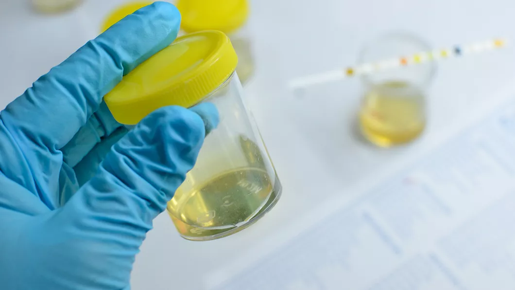 Care este diferența dintre sumarul de urină și urocultură Pregătirea pacientului pentru recoltarea probelor