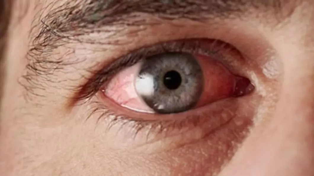 Boli ale ochiului. Cele mai frecvente afecțiuni oculare
