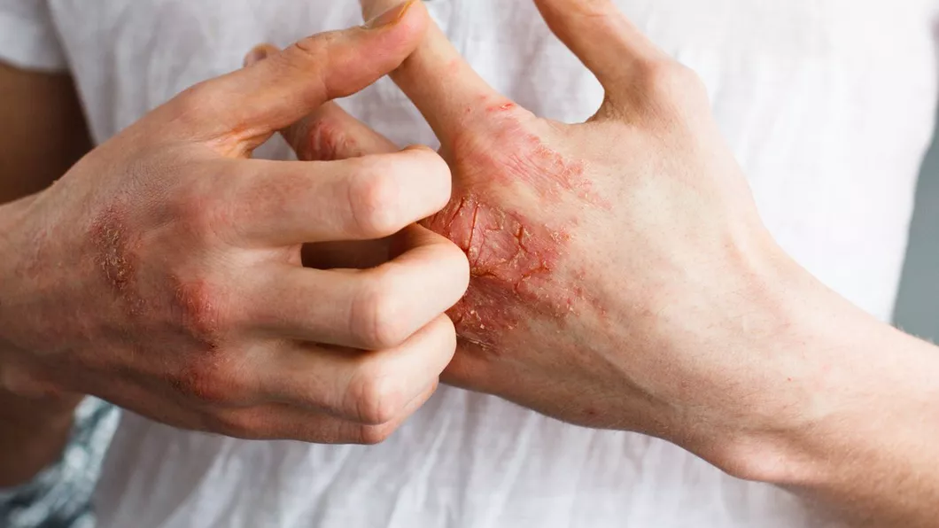 Unguent cu antibiotic pentru eczeme. Cum să scapi rapid de semnele roșii de pe mâini