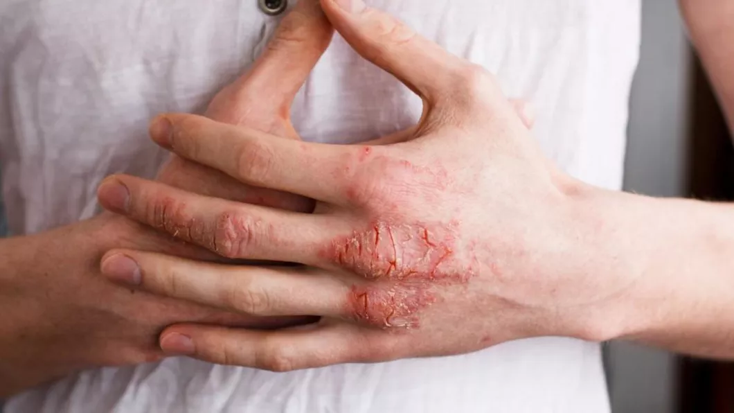 Dermatita herpetiformă. Tratează rapid petele și erupțiile cauzate de boală