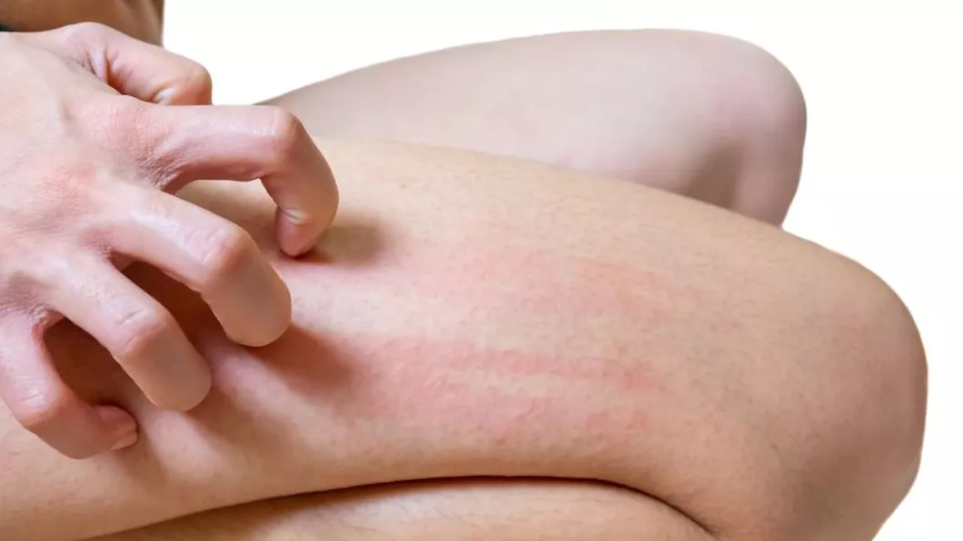 Mâncărimi de piele pe picioare. Situații care pot provoca manifestarea senzației neplăcute