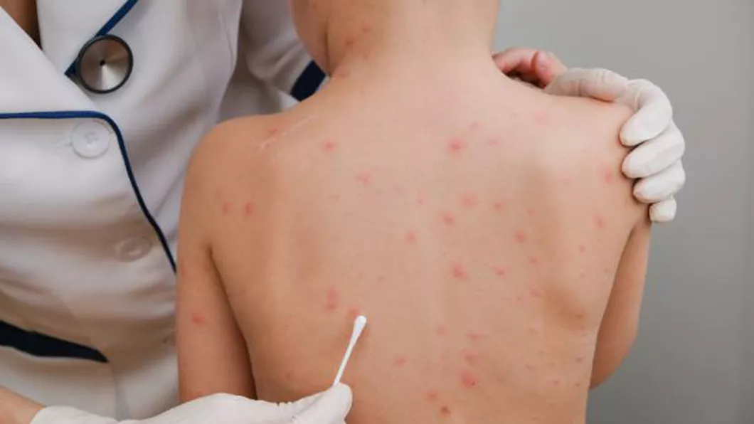 Copil de 7 ani cu o formă de varicelă foarte rară internat la Spitalul de Boli Infecțioase din Timișoara