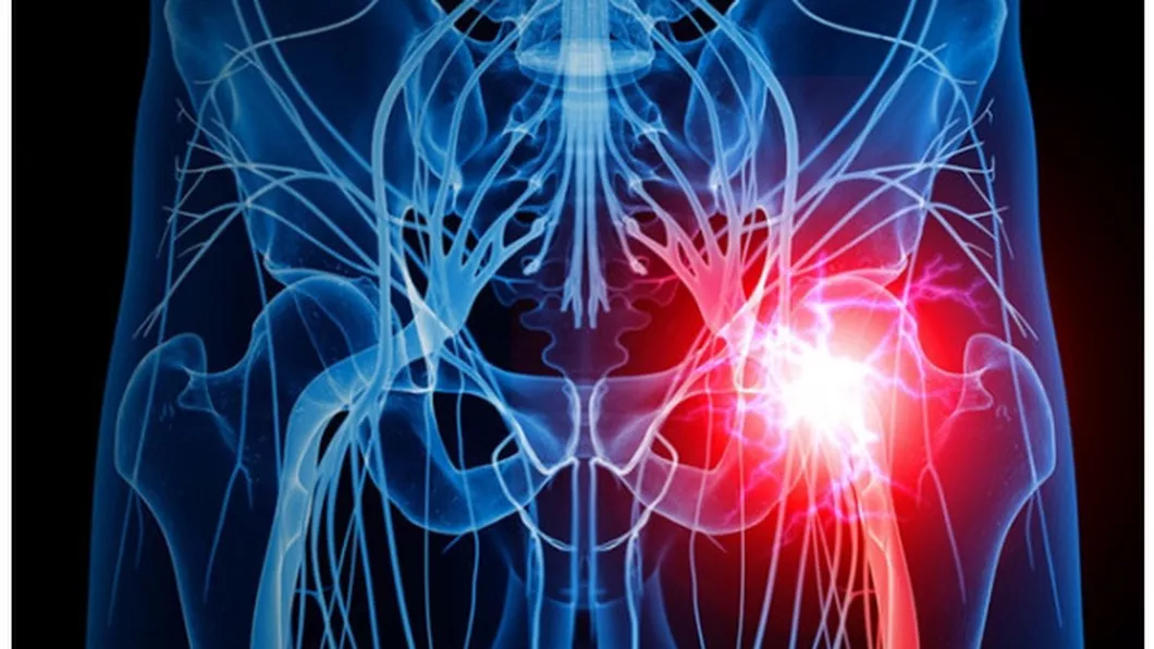 Ce este coxartroza artroza șoldului Cauze simptome și metode de diagnostic