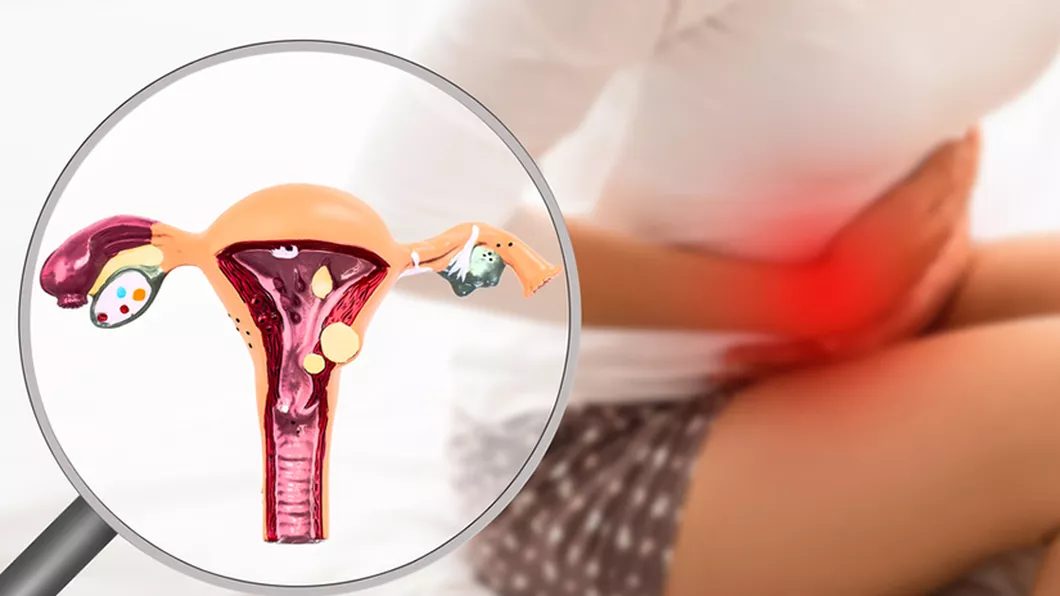Ce este Endometrioza Cum se poate trata și pe cine afectează