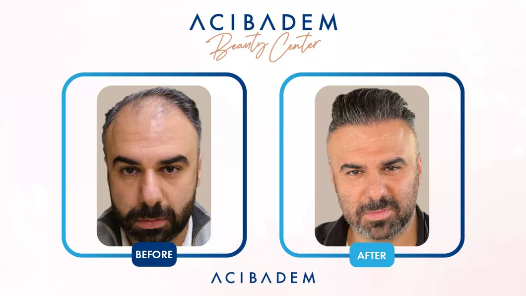 Acibadem Beauty Center Locul Sigur din Turcia Pentru Transplantul de Păr