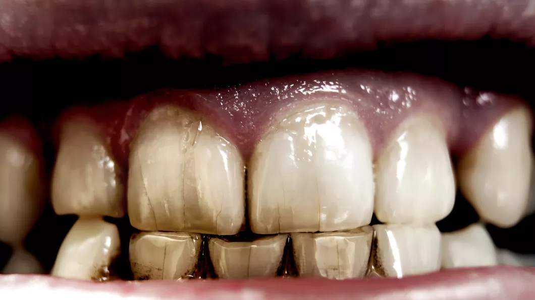 De ce se innegresc dintii