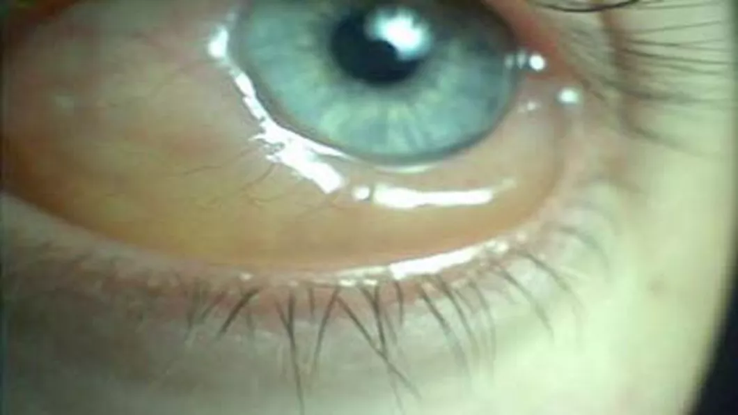 Cum prevenim infectiile ochiului
