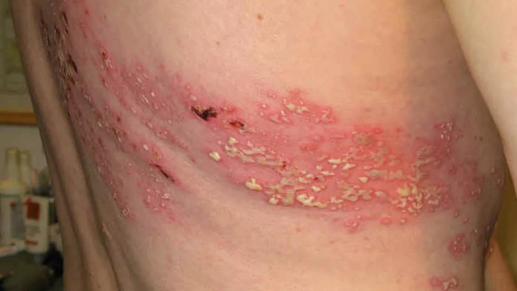 Euvirox crema - tratamentul in faza acuta a herpesului zoster si a varicelei