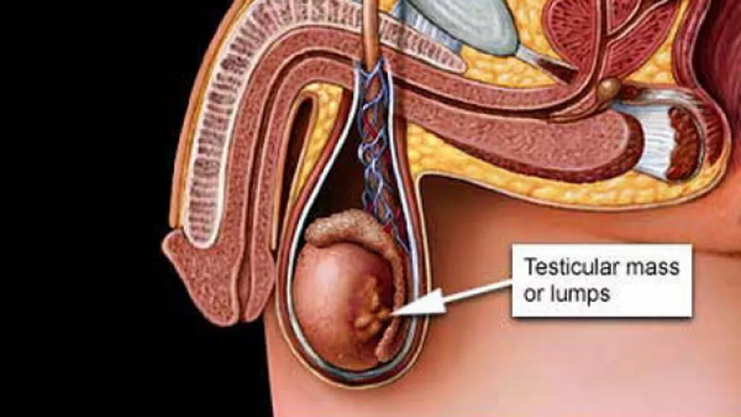 4 mituri despre cancerul testicular