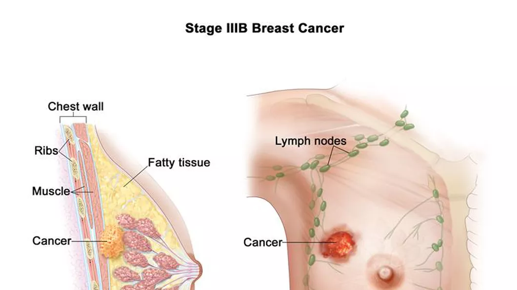  10 mituri depre cancerul de san pe care nu trebuie sa le crezi
