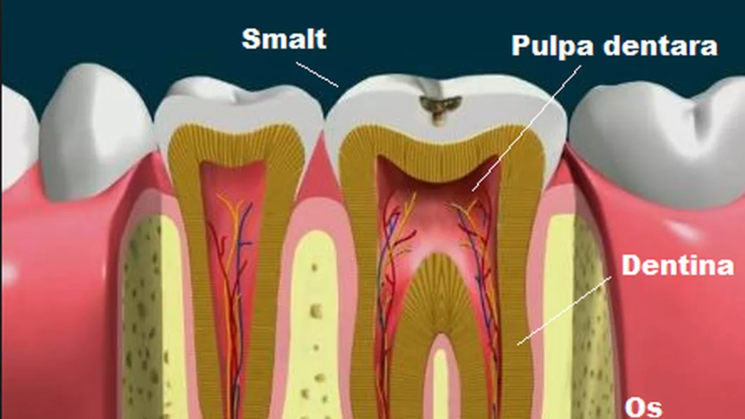 Cand este indicata scoaterea nervului dentar