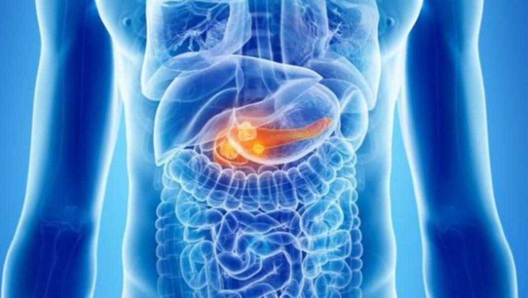 Tot Mai Multi Bolnavi De Cancerul La Pancreas Care Sunt