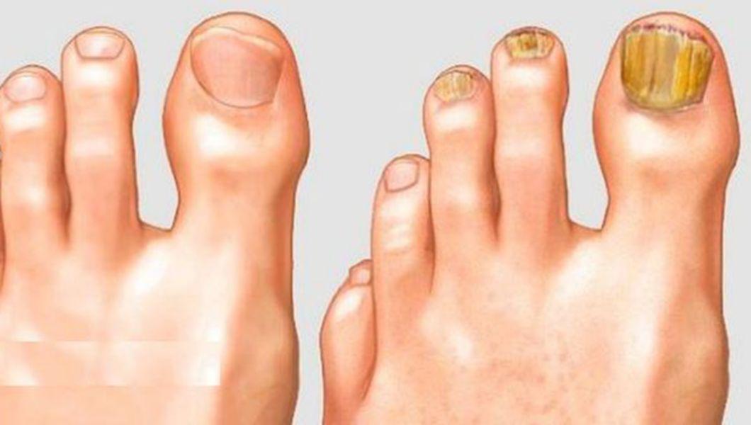 1 ciuperca unghiei degetului de la picioare