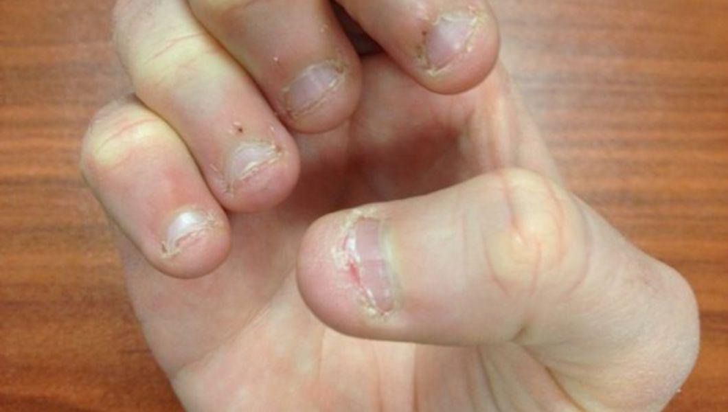 cum să depistați ciuperca unghiilor pe mâini