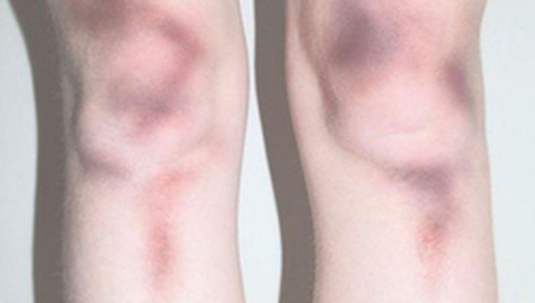 Daca Ai Astfel De Pete Pe Corp Mergi De Urgenta La Medic Boala Afecteaza Femeile Si Este Aproape Necunoscuta Buna Ziua Iasi Bzi Ro