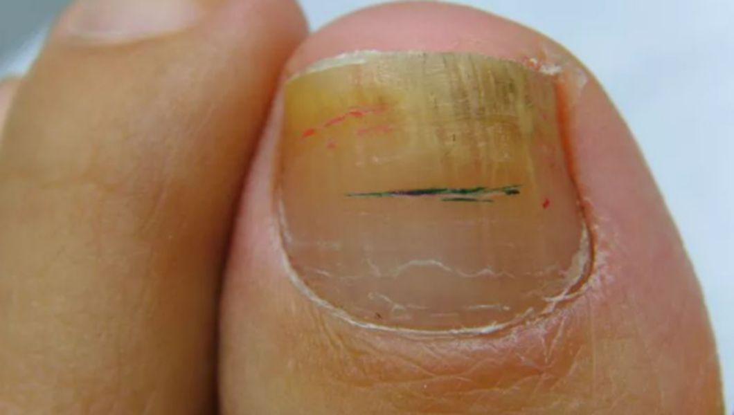 cum să vindeci foarte repede ciuperca unghiilor