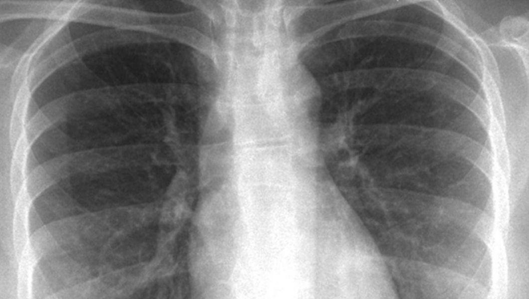 De Ce Apar Nodulii Pulmonari Pneumonia Sau Tuberculoza