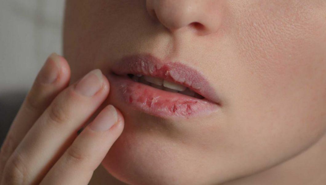 Deficienta De Fier Aceste Semne In Gura Si In Jurul Ei Pot Semnala Lipsa De Fier Buna Ziua Iasi Bzi Ro