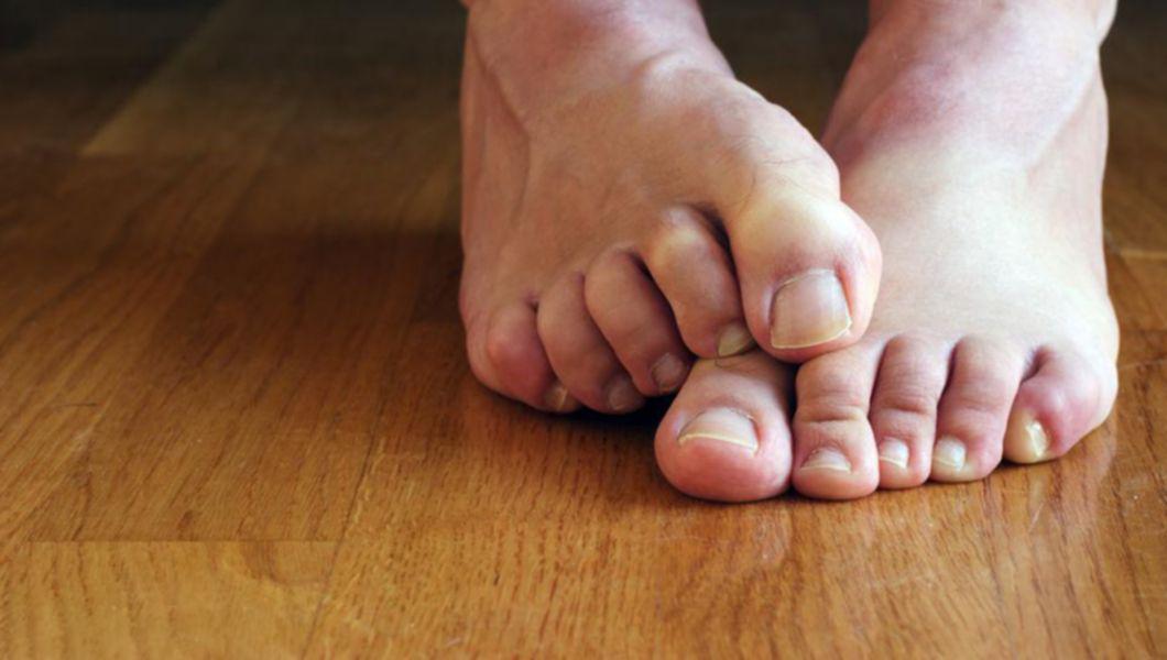 stadiul ciupercii degetelor de la picioare ce este bun pentru ciuperca unghiilor