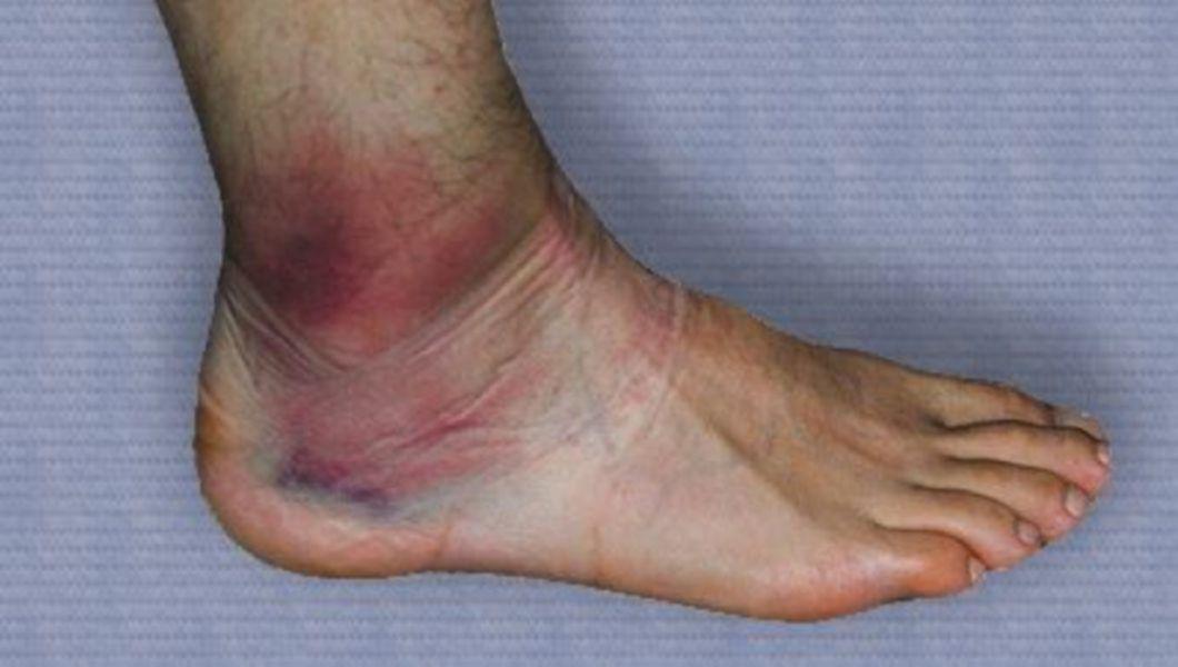 Inflamația piciorului și a gleznei
